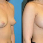 Breast Implant #62 - Before and After