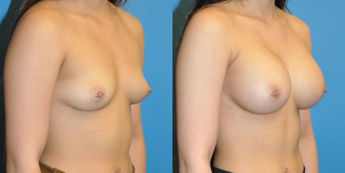 Breast Implant #62 - Before and After