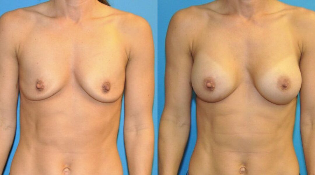 Breast Implant #63
