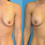 Breast Implant #63 - Before and After