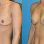 Breast Implant #63 - Before and After