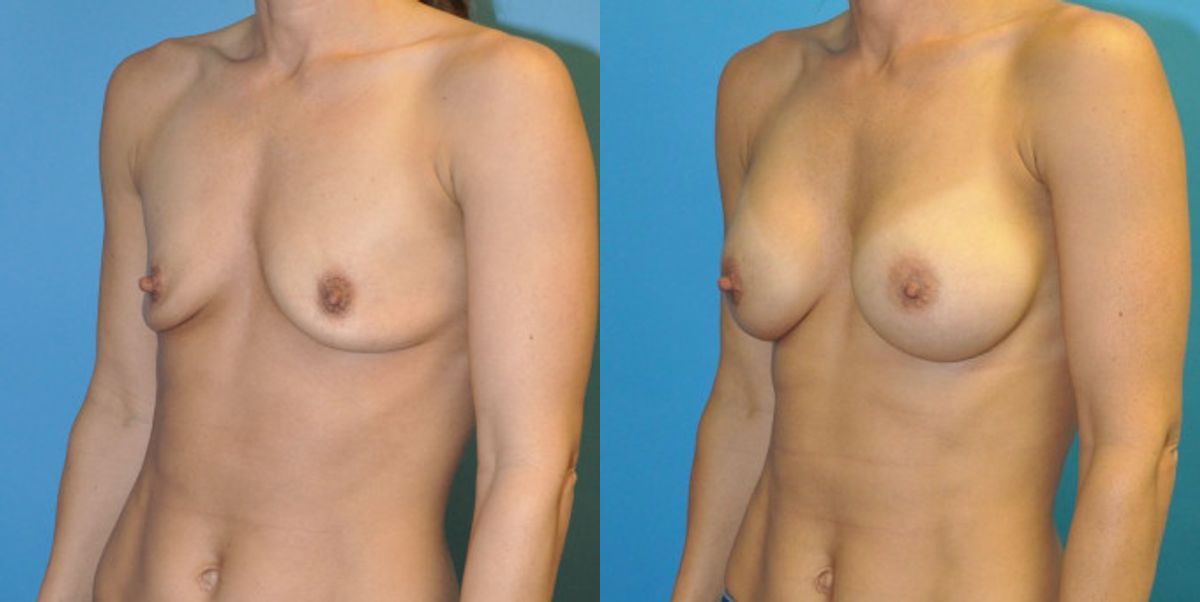 Breast Implant #63 - Before and After