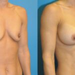 Breast Implant #63 - Before and After