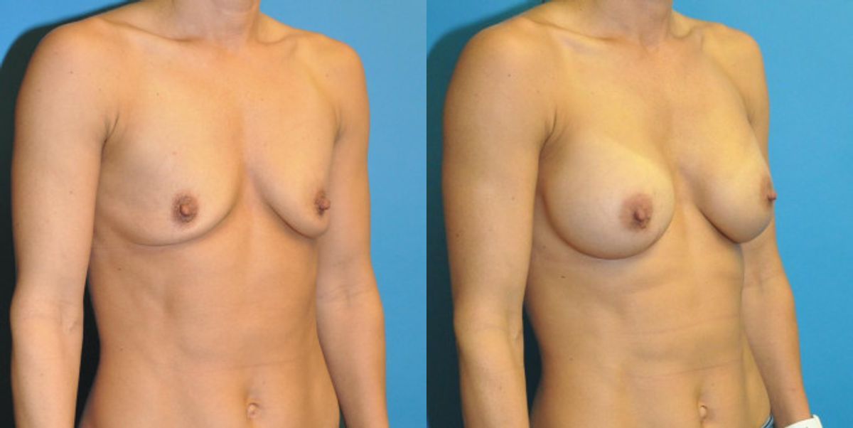 Breast Implant #63 - Before and After