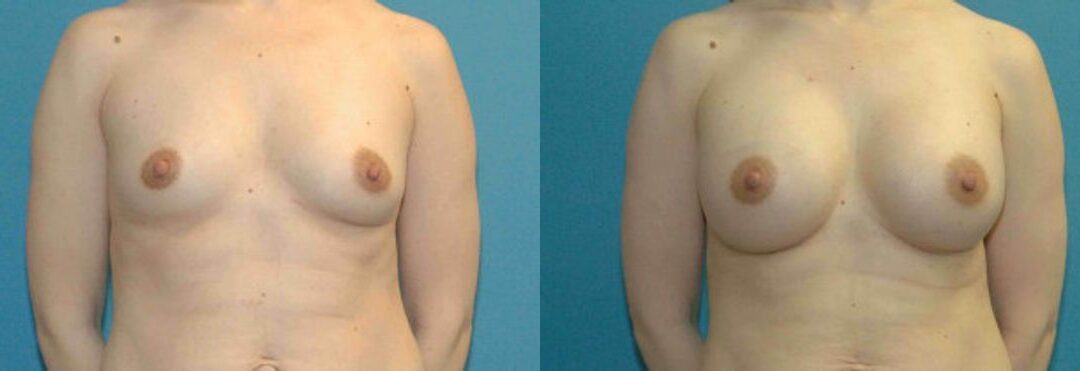 Breast Implant #64