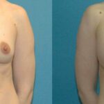 Breast Implant #64 - Before and After