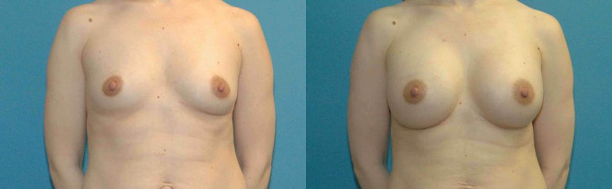 Breast Implant #64 - Before and After