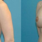 Breast Implant #64 - Before and After