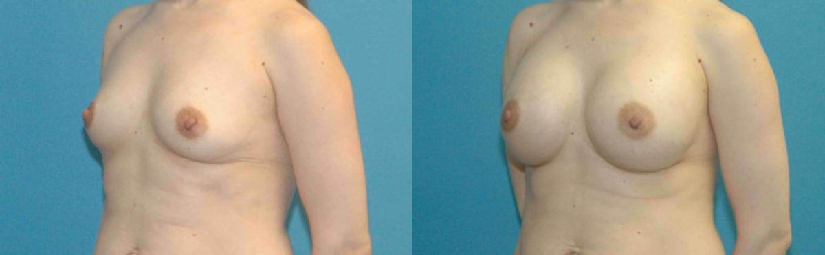 Breast Implant #64 - Before and After