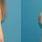 Breast Implant #64 - Before and After