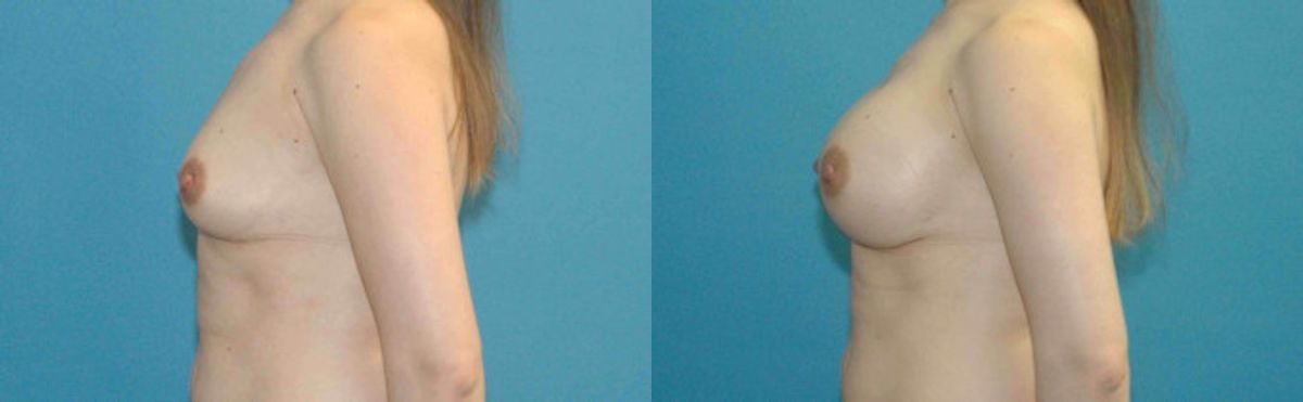 Breast Implant #64 - Before and After