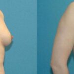 Breast Implant #64 - Before and After
