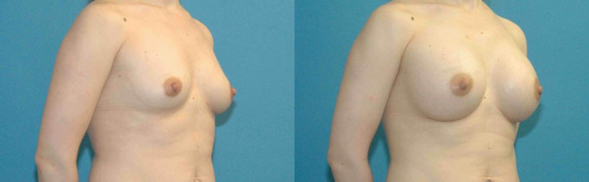 Breast Implant #64 - Before and After
