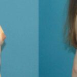 Breast Implant #64 - Before and After