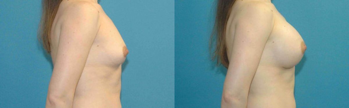 Breast Implant #64 - Before and After