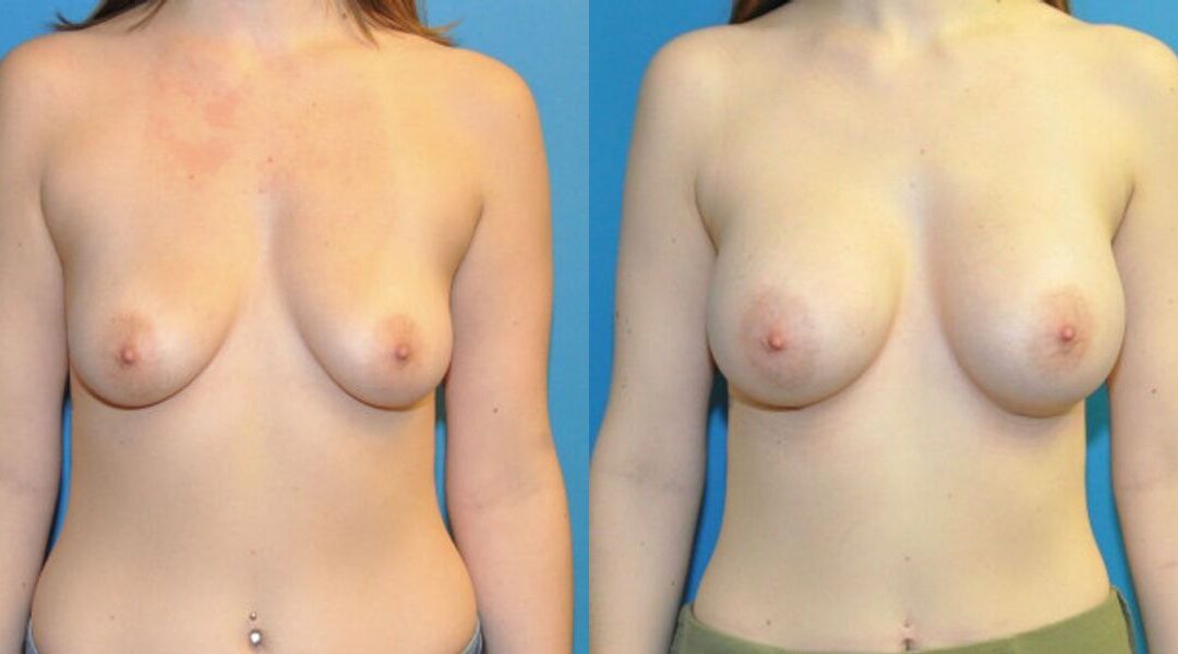 Breast Implant #65