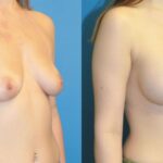 Breast Implant #65 - Before and After