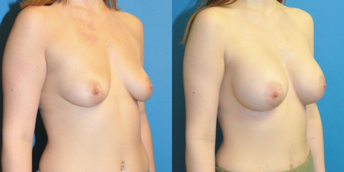 Breast Implant #65 - Before and After