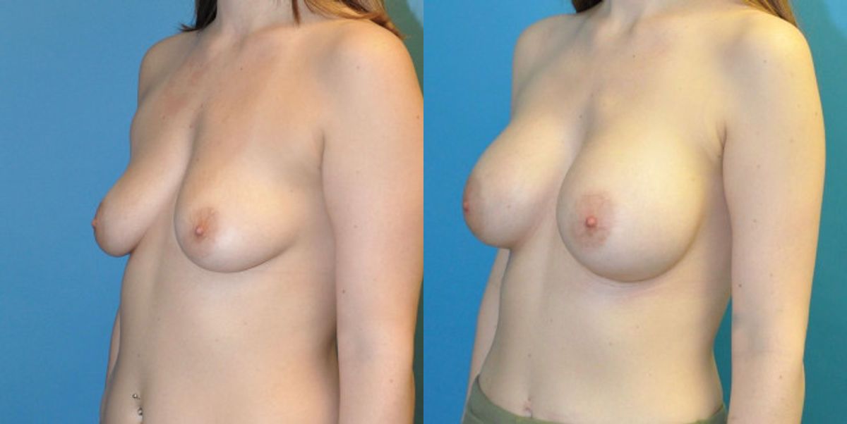 Breast Implant #65 - Before and After