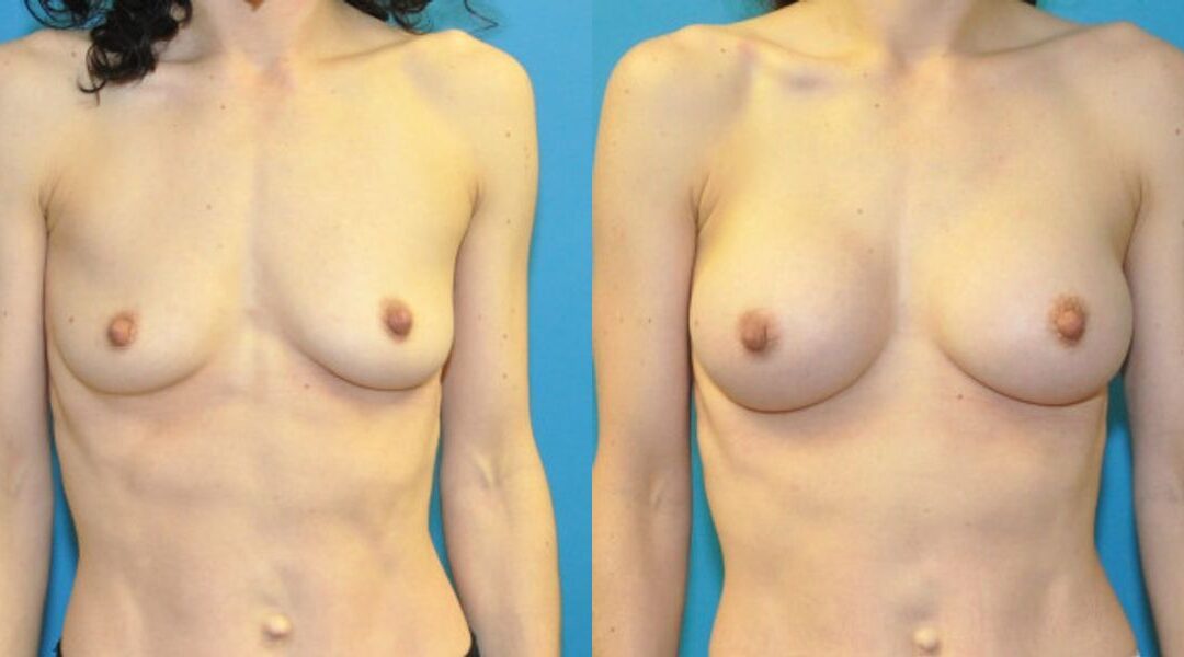 Breast Implant #66
