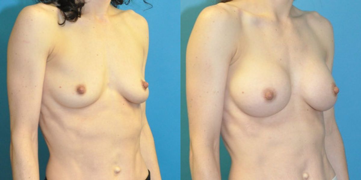 Breast Implant #66 - Before and After