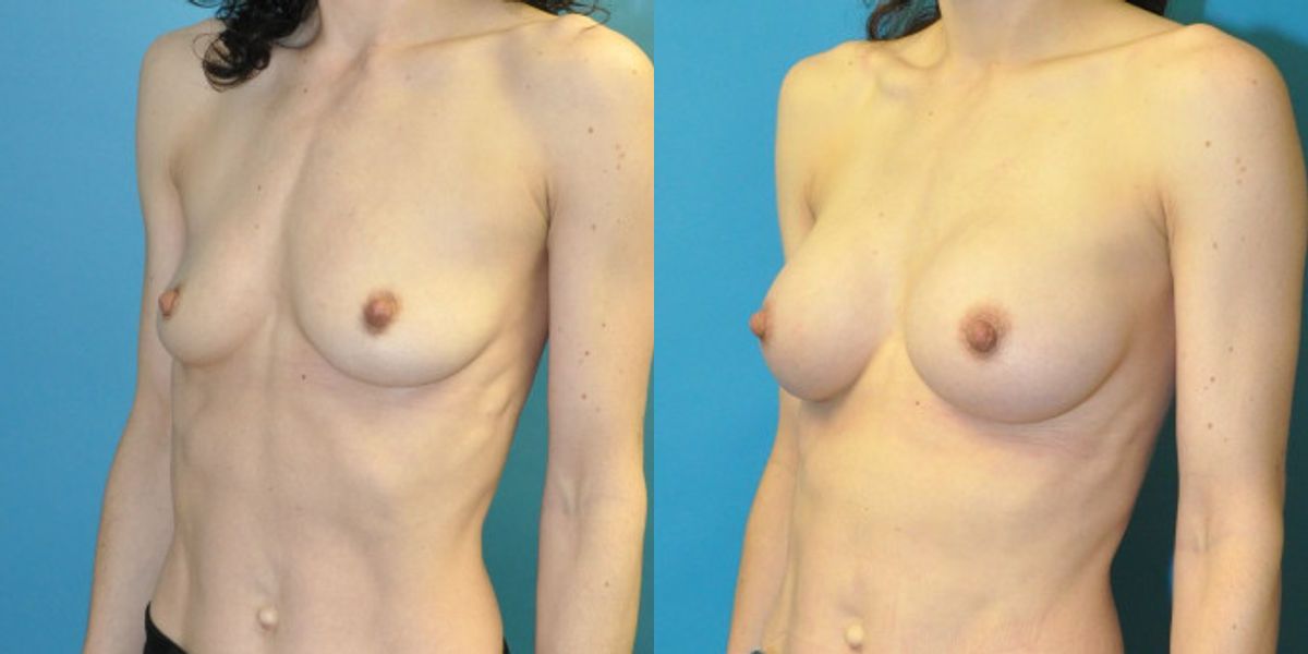Breast Implant #66 - Before and After
