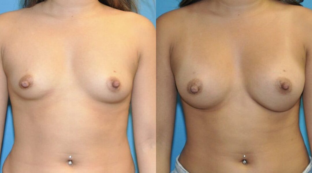 Breast Implant #67