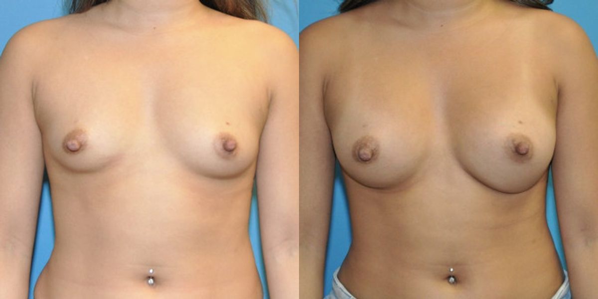Breast Implant #67 - Before and After