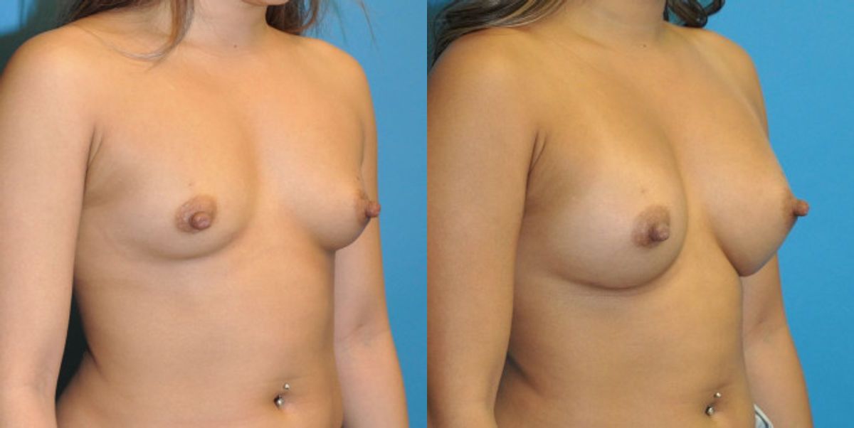 Breast Implant #67 - Before and After