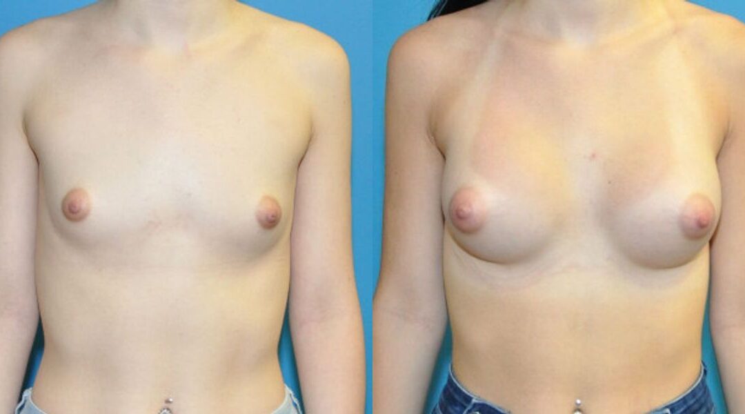 Breast Implant #68
