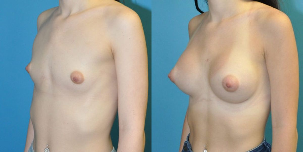 Breast Implant #68 - Before and After