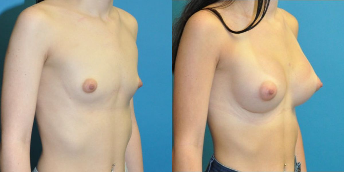 Breast Implant #68 - Before and After