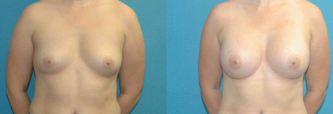 Breast Implant #69