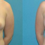 Breast Implant #69 - Before and After
