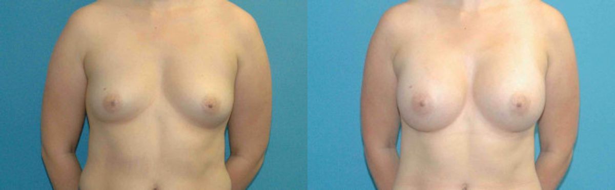 Breast Implant #69 - Before and After