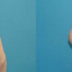 Breast Implant #69 - Before and After