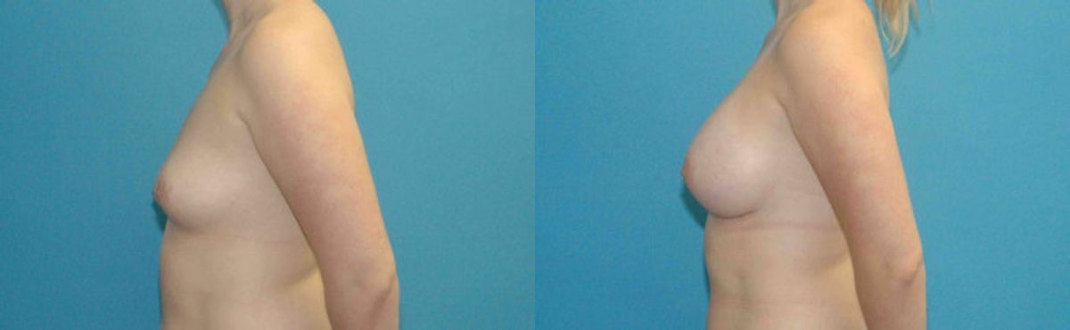 Breast Implant #69 - Before and After