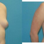 Breast Implant #69 - Before and After