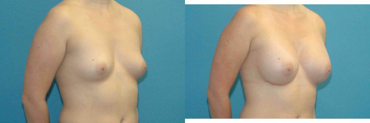 Breast Implant #69 - Before and After