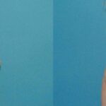 Breast Implant #69 - Before and After