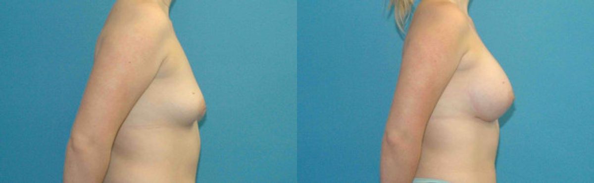 Breast Implant #69 - Before and After