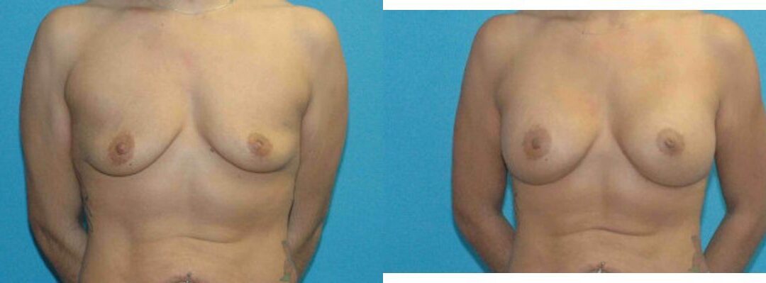 Breast Implant #70