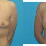Breast Implant #70 - Before and After