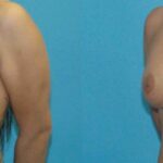 Breast Implant #70 - Before and After
