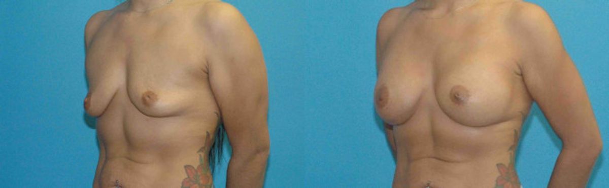 Breast Implant #70 - Before and After