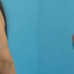 Breast Implant #70 - Before and After