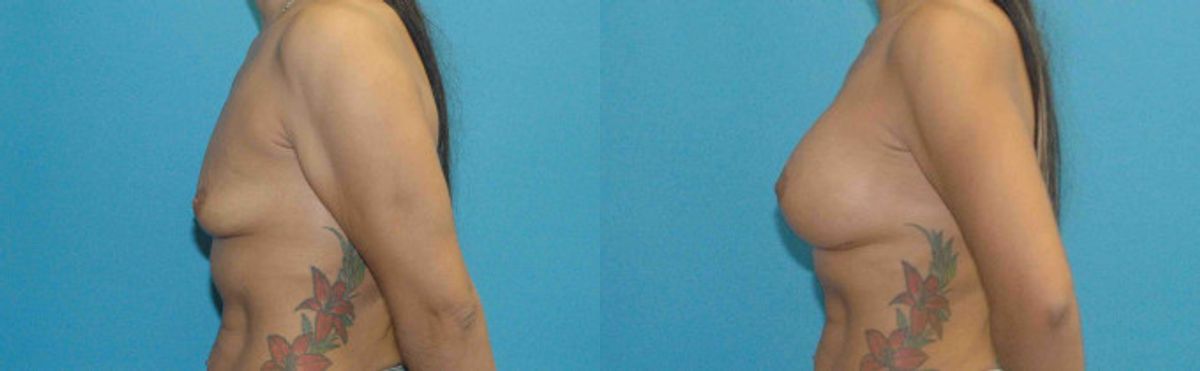 Breast Implant #70 - Before and After