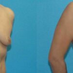 Breast Implant #70 - Before and After