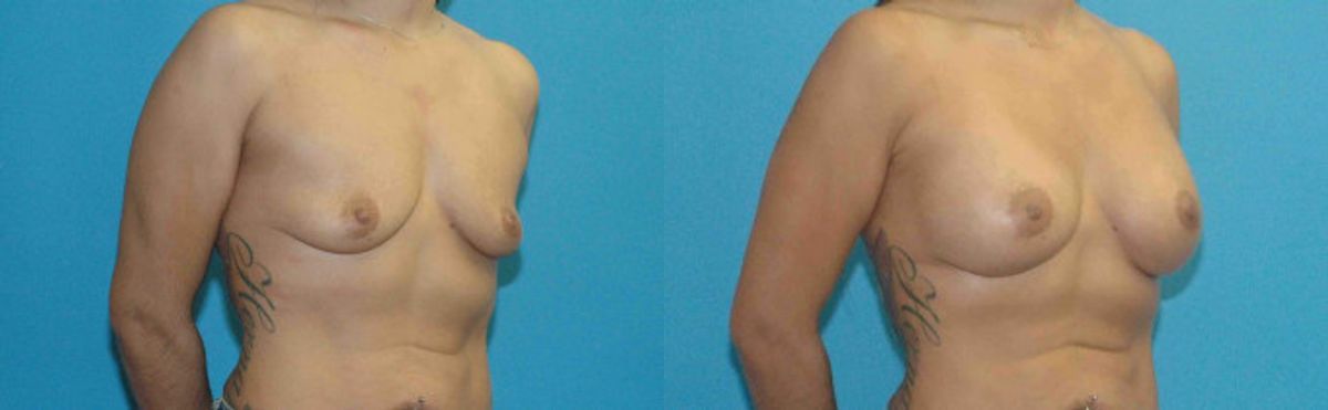 Breast Implant #70 - Before and After