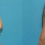 Breast Implant #70 - Before and After